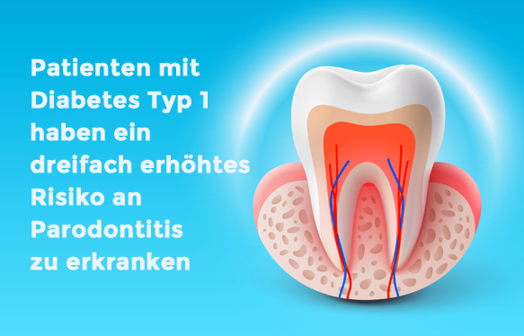 Grafik eines gesunden Zahnes und Zahnhalteapparates