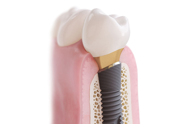 implantat dentsply sirona