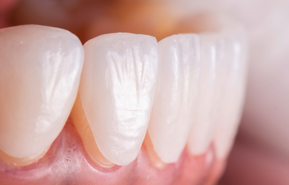 Close-Up Foto von 5 zarten Veneers eines Unterkiefers